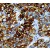 Immunohistochemistry-Paraffin: Cytokeratin 14 Antibody (LL002) [NB100-65109] - Formalin fixed paraffin embedded human squamous cell carcinoma of lung stained with Cytokeratin 14 antibody.